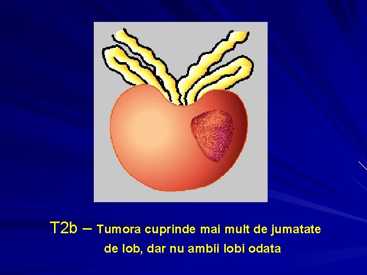 T 2 b – Tumora cuprinde mai mult de jumatate de lob, dar nu T 2 b – Tumora cuprinde mai mult de jumatate de lob, dar nu