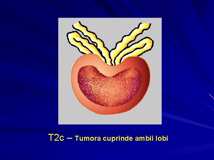 T 2 c – Tumora cuprinde ambii lobi T 2 c – Tumora cuprinde ambii lobi