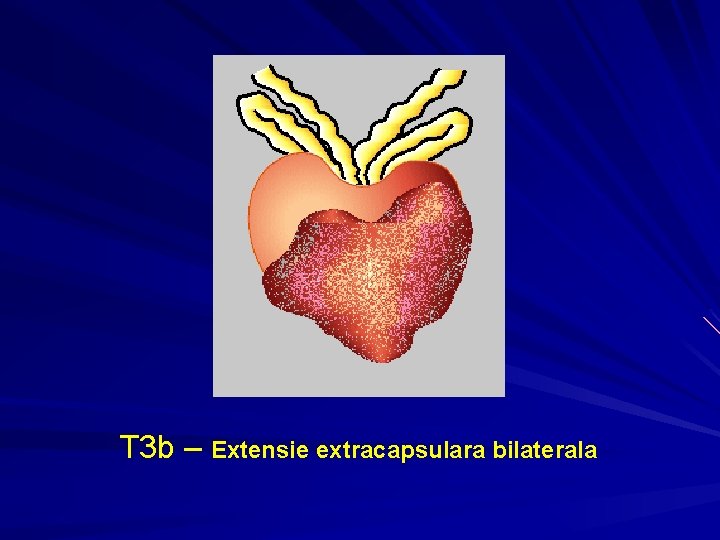 T 3 b – Extensie extracapsulara bilaterala T 3 b – Extensie extracapsulara bilaterala