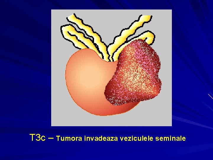 T 3 c – Tumora invadeaza veziculele seminale T 3 c – Tumora invadeaza veziculele seminale