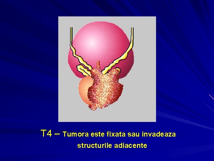 T 4 – Tumora este fixata sau invadeaza structurile adiacente T 4 – Tumora este fixata sau invadeaza structurile adiacente