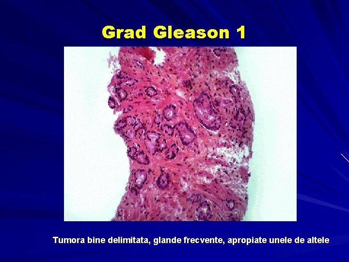 Grad Gleason 1 Tumora bine delimitata, glande frecvente, apropiate unele de altele Grad Gleason 1 Tumora bine delimitata, glande frecvente, apropiate unele de altele