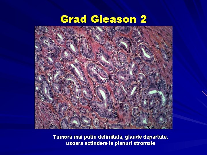 Grad Gleason 2 Tumora mai putin delimitata, glande departate, usoara extindere la planuri stromale Grad Gleason 2 Tumora mai putin delimitata, glande departate, usoara extindere la planuri stromale
