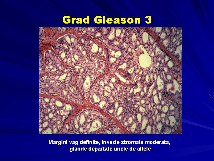 Grad Gleason 3 Margini vag definite, invazie stromala moderata, glande departate unele de altele Grad Gleason 3 Margini vag definite, invazie stromala moderata, glande departate unele de altele