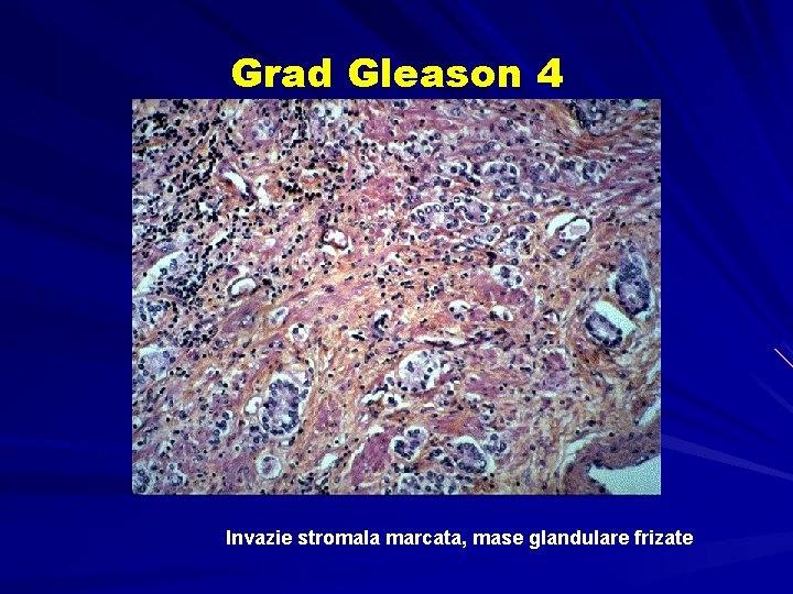 Grad Gleason 4 Invazie stromala marcata, mase glandulare frizate Grad Gleason 4 Invazie stromala marcata, mase glandulare frizate