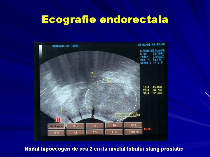 prostata dimensiuni normale ecografie Echo krónikus prosztatitis