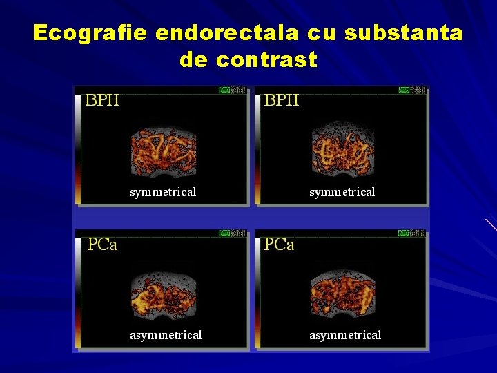 Ecografie endorectala cu substanta de contrast Ecografie endorectala cu substanta de contrast