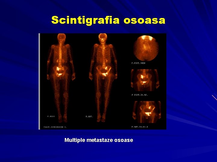 Scintigrafia osoasa Multiple metastaze osoase Scintigrafia osoasa Multiple metastaze osoase