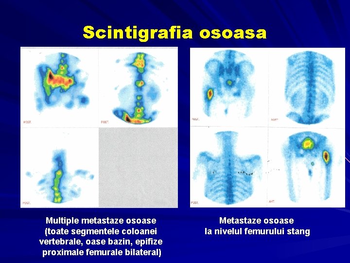 Scintigrafia osoasa Multiple metastaze osoase (toate segmentele coloanei vertebrale, oase bazin, epifize proximale femurale Scintigrafia osoasa Multiple metastaze osoase (toate segmentele coloanei vertebrale, oase bazin, epifize proximale femurale