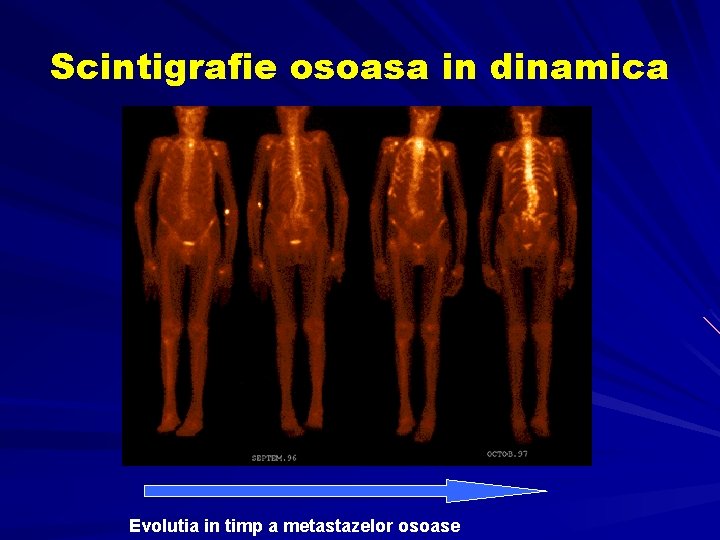 Scintigrafie osoasa in dinamica Evolutia in timp a metastazelor osoase Scintigrafie osoasa in dinamica Evolutia in timp a metastazelor osoase