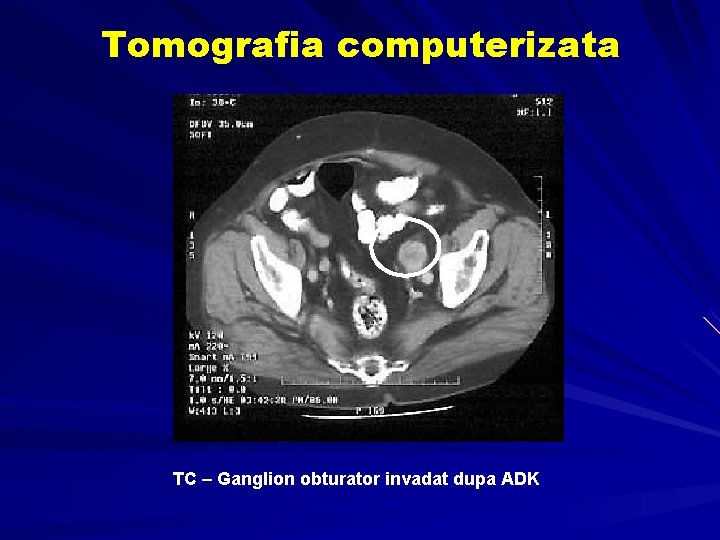 tomografie computerizată prostatita)