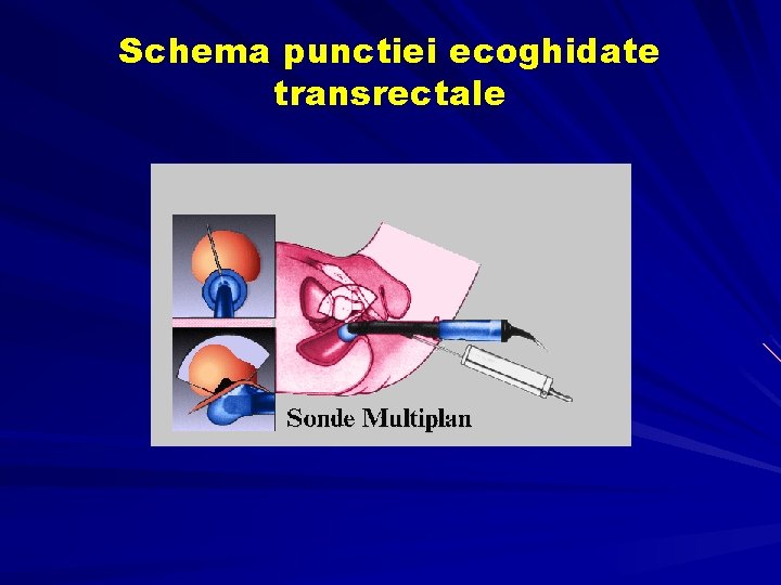 Schema punctiei ecoghidate transrectale Schema punctiei ecoghidate transrectale