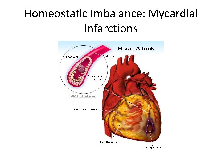 Homeostatic Imbalance: Mycardial Infarctions 