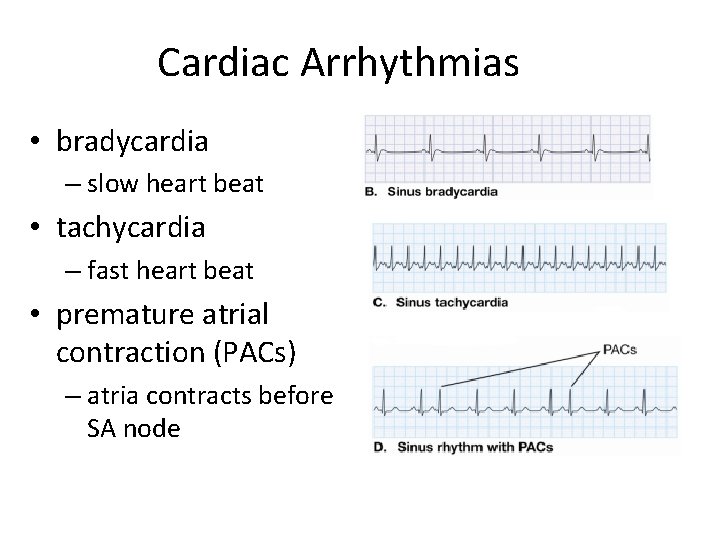 Cardiac Arrhythmias • bradycardia – slow heart beat • tachycardia – fast heart beat