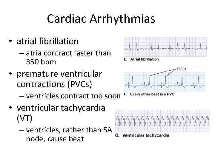 Cardiac Arrhythmias • atrial fibrillation – atria contract faster than 350 bpm • premature