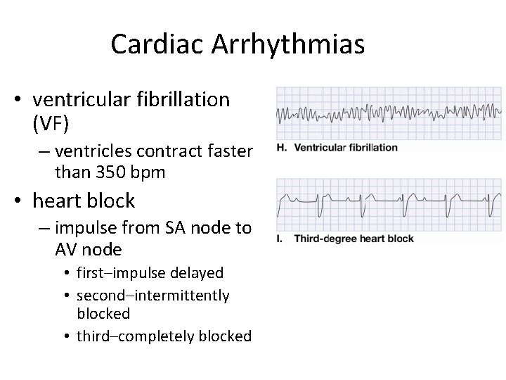 Cardiac Arrhythmias • ventricular fibrillation (VF) – ventricles contract faster than 350 bpm •