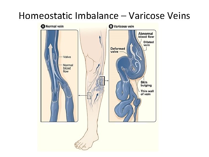 Homeostatic Imbalance – Varicose Veins 