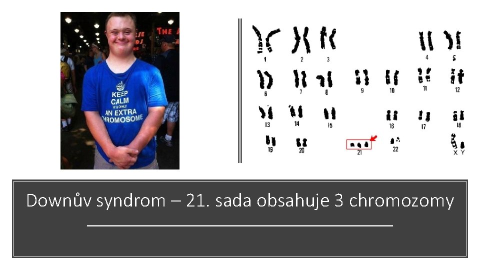 Downův syndrom – 21. sada obsahuje 3 chromozomy 