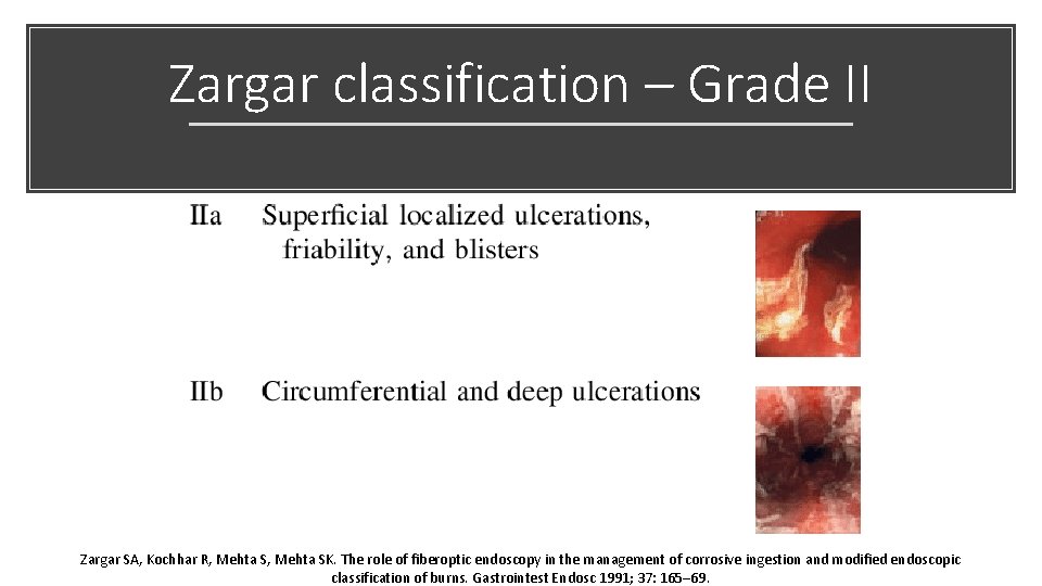 Zargar classification – Grade II Zargar SA, Kochhar R, Mehta SK. The role of