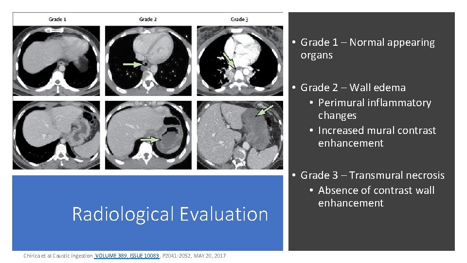 • Grade 1 – Normal appearing organs • Grade 2 – Wall edema