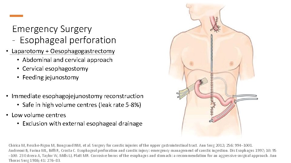 Emergency Surgery - Esophageal perforation • Laparotomy + Oesophagogastrectomy • Abdominal and cervical approach