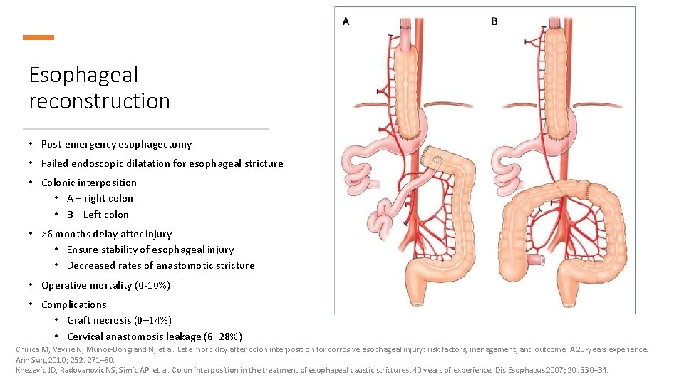 Esophageal reconstruction • Post-emergency esophagectomy • Failed endoscopic dilatation for esophageal stricture • Colonic