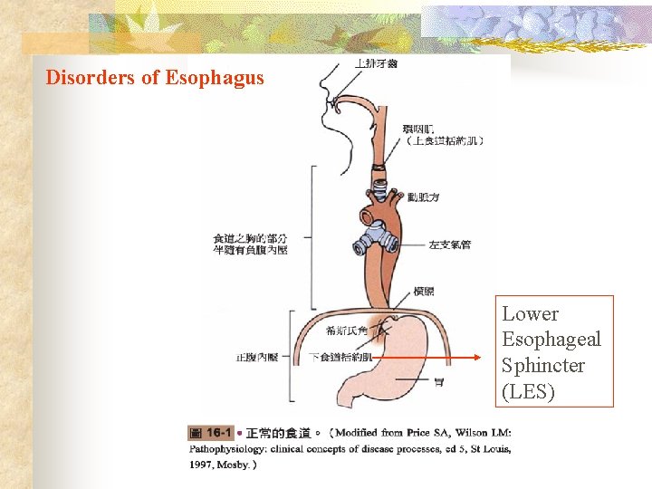 Disorders of Esophagus Lower Esophageal Sphincter (LES) 