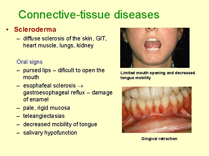 Connective-tissue diseases • Scleroderma – diffuse sclerosis of the skin, GIT, heart muscle, lungs, Connective-tissue diseases • Scleroderma – diffuse sclerosis of the skin, GIT, heart muscle, lungs,