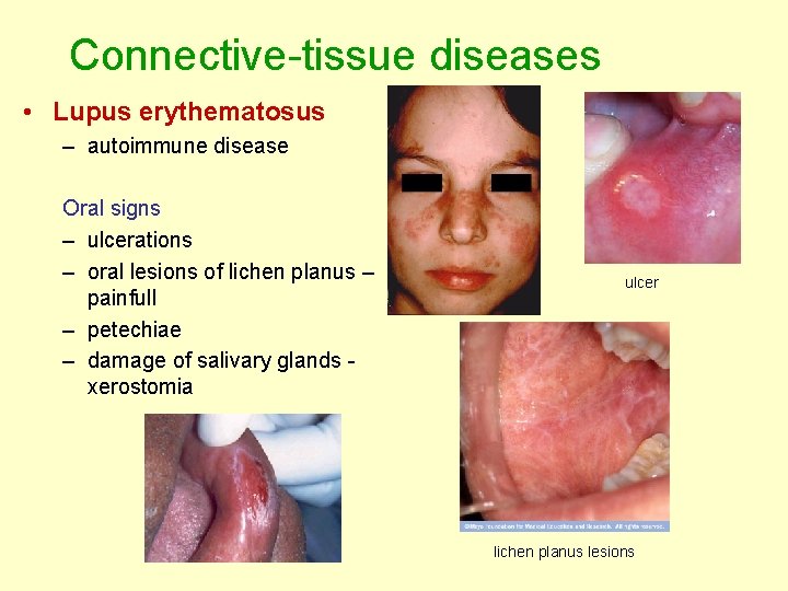 Connective-tissue diseases • Lupus erythematosus – autoimmune disease Oral signs – ulcerations – oral Connective-tissue diseases • Lupus erythematosus – autoimmune disease Oral signs – ulcerations – oral