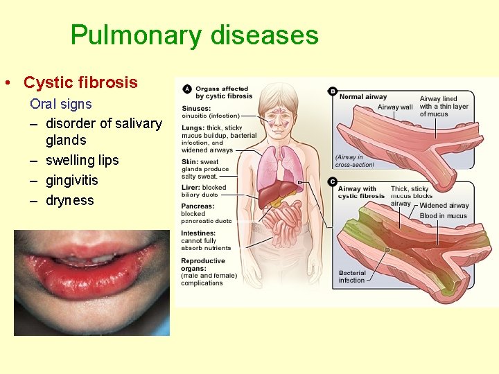 Pulmonary diseases • Cystic fibrosis Oral signs – disorder of salivary glands – swelling Pulmonary diseases • Cystic fibrosis Oral signs – disorder of salivary glands – swelling