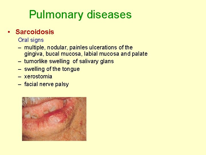Pulmonary diseases • Sarcoidosis Oral signs – multiple, nodular, painles ulcerations of the gingiva, Pulmonary diseases • Sarcoidosis Oral signs – multiple, nodular, painles ulcerations of the gingiva,