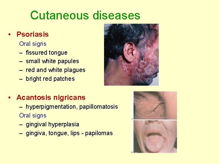 Cutaneous diseases • Psoriasis Oral signs – fissured tongue – small white papules – Cutaneous diseases • Psoriasis Oral signs – fissured tongue – small white papules –