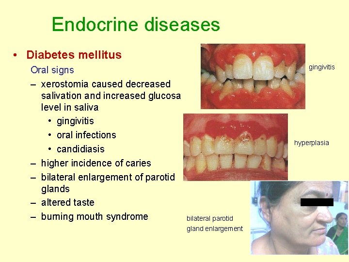 Endocrine diseases • Diabetes mellitus Oral signs – xerostomia caused decreased salivation and increased Endocrine diseases • Diabetes mellitus Oral signs – xerostomia caused decreased salivation and increased