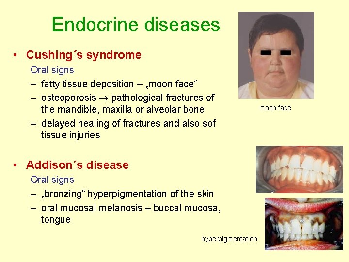 Endocrine diseases • Cushing´s syndrome Oral signs – fatty tissue deposition – „moon face“ Endocrine diseases • Cushing´s syndrome Oral signs – fatty tissue deposition – „moon face“