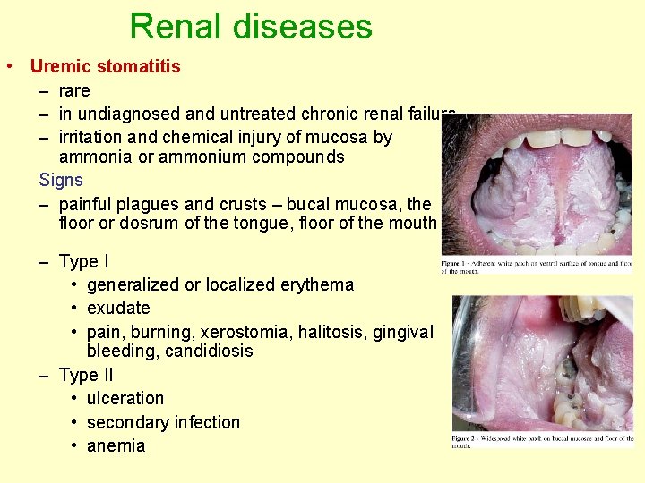 Renal diseases • Uremic stomatitis – rare – in undiagnosed and untreated chronic renal Renal diseases • Uremic stomatitis – rare – in undiagnosed and untreated chronic renal