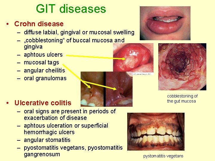 GIT diseases • Crohn disease – diffuse labial, gingival or mucosal swelling – „cobblestoning“ GIT diseases • Crohn disease – diffuse labial, gingival or mucosal swelling – „cobblestoning“