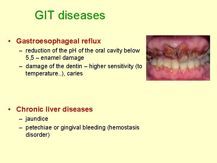 GIT diseases • Gastroesophageal reflux – reduction of the p. H of the oral GIT diseases • Gastroesophageal reflux – reduction of the p. H of the oral