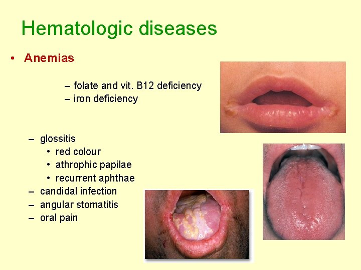 Hematologic diseases • Anemias – folate and vit. B 12 deficiency – iron deficiency Hematologic diseases • Anemias – folate and vit. B 12 deficiency – iron deficiency