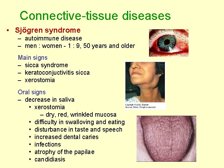 Connective-tissue diseases • Sjögren syndrome – autoimmune disease – men : women - 1 Connective-tissue diseases • Sjögren syndrome – autoimmune disease – men : women - 1