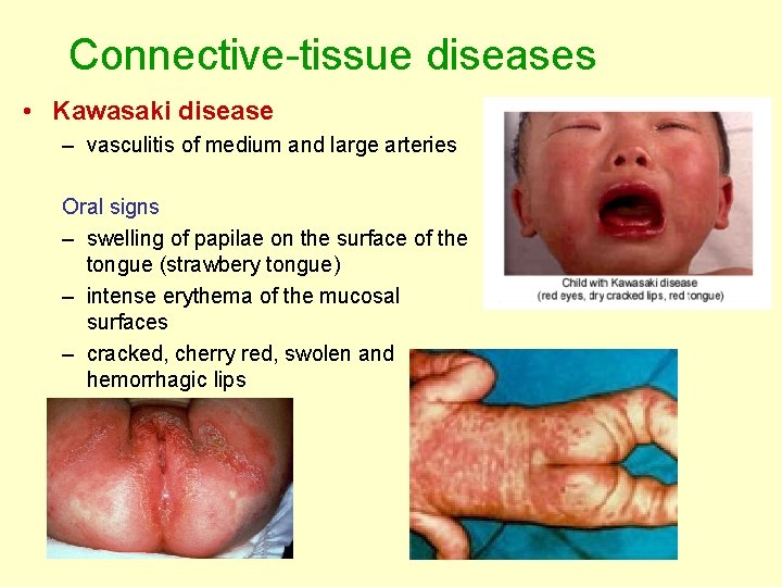 Connective-tissue diseases • Kawasaki disease – vasculitis of medium and large arteries Oral signs Connective-tissue diseases • Kawasaki disease – vasculitis of medium and large arteries Oral signs
