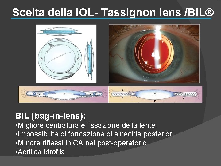 Scelta della IOL- Tassignon lens /BIL® BIL (bag-in-lens): • Migliore centratura e fissazione della