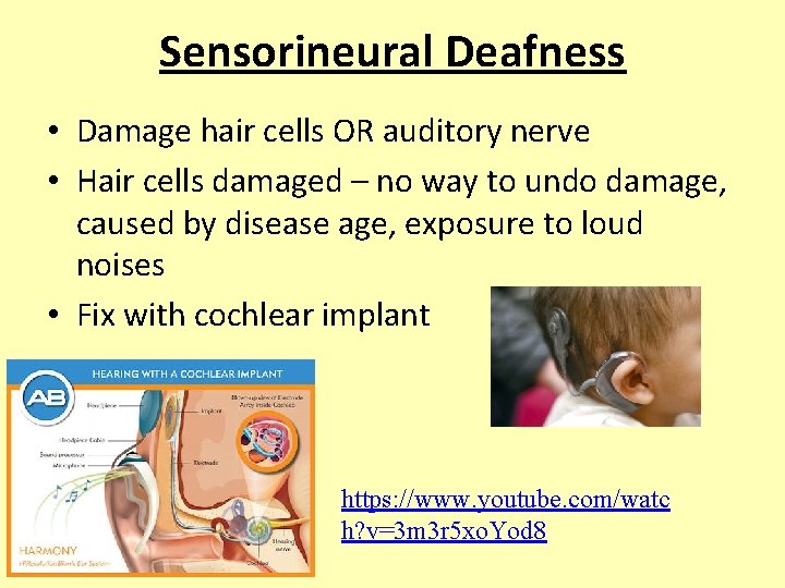 Sensorineural Deafness • Damage hair cells OR auditory nerve • Hair cells damaged – Sensorineural Deafness • Damage hair cells OR auditory nerve • Hair cells damaged –