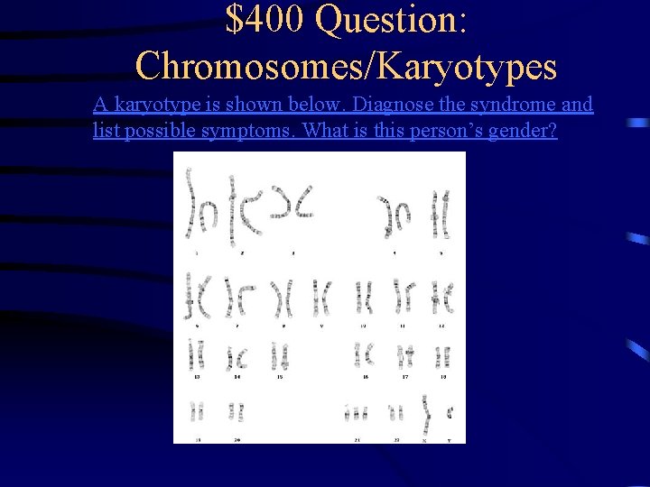$400 Question: Chromosomes/Karyotypes A karyotype is shown below. Diagnose the syndrome and list possible $400 Question: Chromosomes/Karyotypes A karyotype is shown below. Diagnose the syndrome and list possible