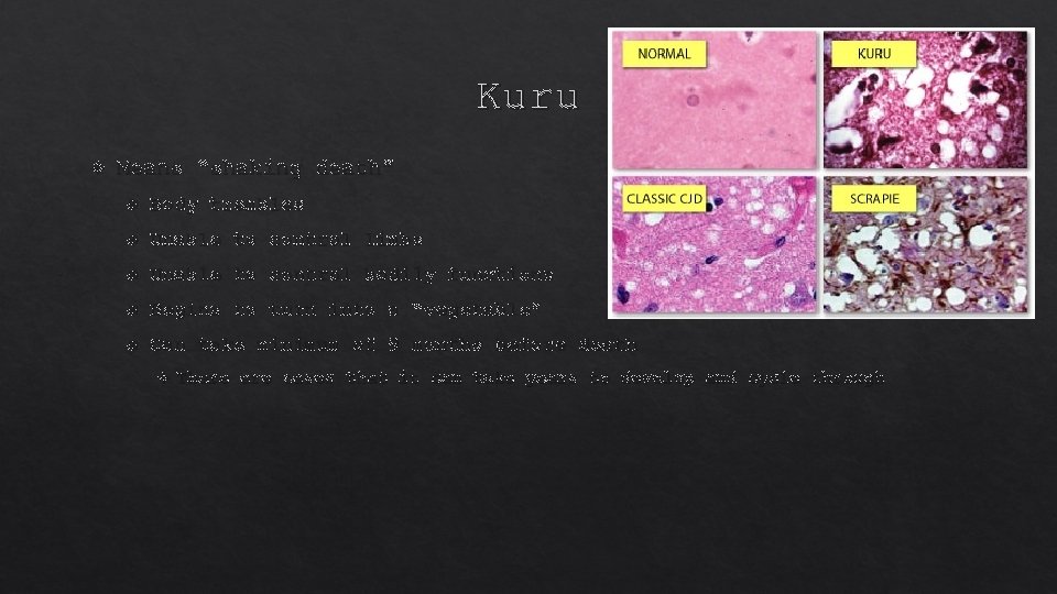 Kuru Means “shaking death” Body trembles Unable to control limbs Unable to control bodily