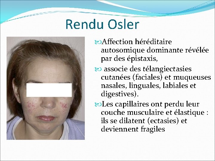 Rendu Osler Affection héréditaire autosomique dominante révélée par des épistaxis, associe des télangiectasies cutanées Rendu Osler Affection héréditaire autosomique dominante révélée par des épistaxis, associe des télangiectasies cutanées