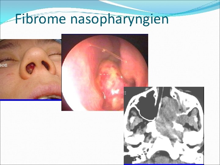 Fibrome nasopharyngien Fibrome nasopharyngien