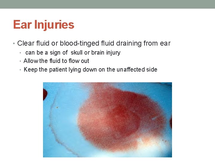 Ear Injuries • Clear fluid or blood-tinged fluid draining from ear • can be