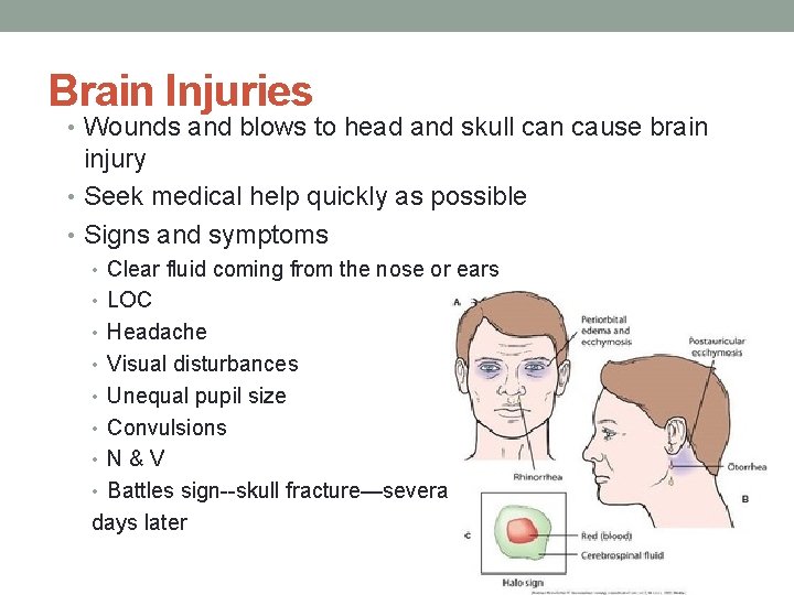 Brain Injuries • Wounds and blows to head and skull can cause brain injury