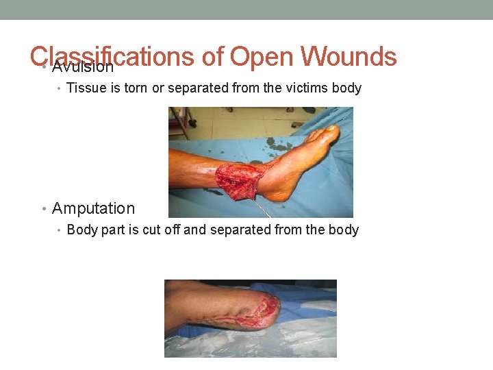 Classifications of Open Wounds • Avulsion • Tissue is torn or separated from the