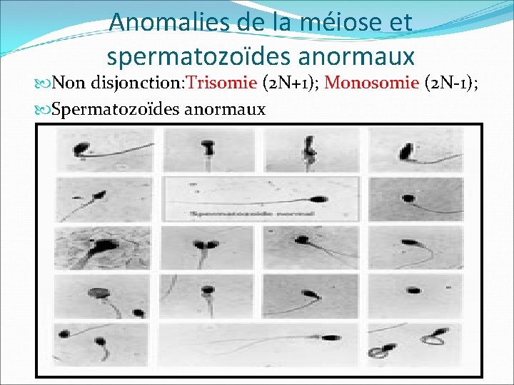 Anomalies de la méiose et spermatozoïdes anormaux Non disjonction: Trisomie (2 N+1); Monosomie (2